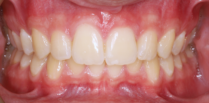 Stan po leczeniu - przypadek 3