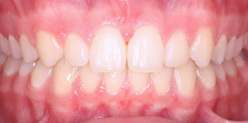 Stan po leczeniu - przypadek 5