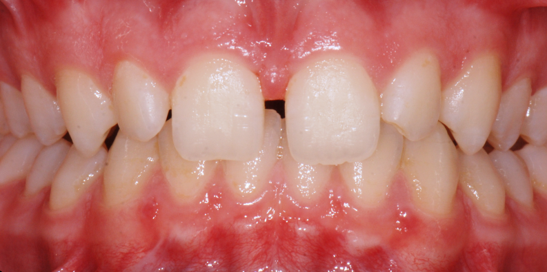 Stan przed leczeniem - przypadek 5