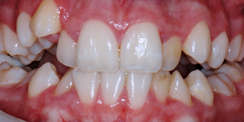 Stan przed leczeniem - przypadek 6